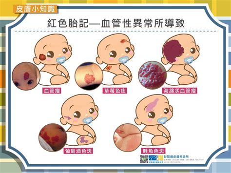 胎記是什麼